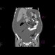 Pancreatic carcinoma, carcinomatous peritonitis, ascites: CT - Computed tomography
